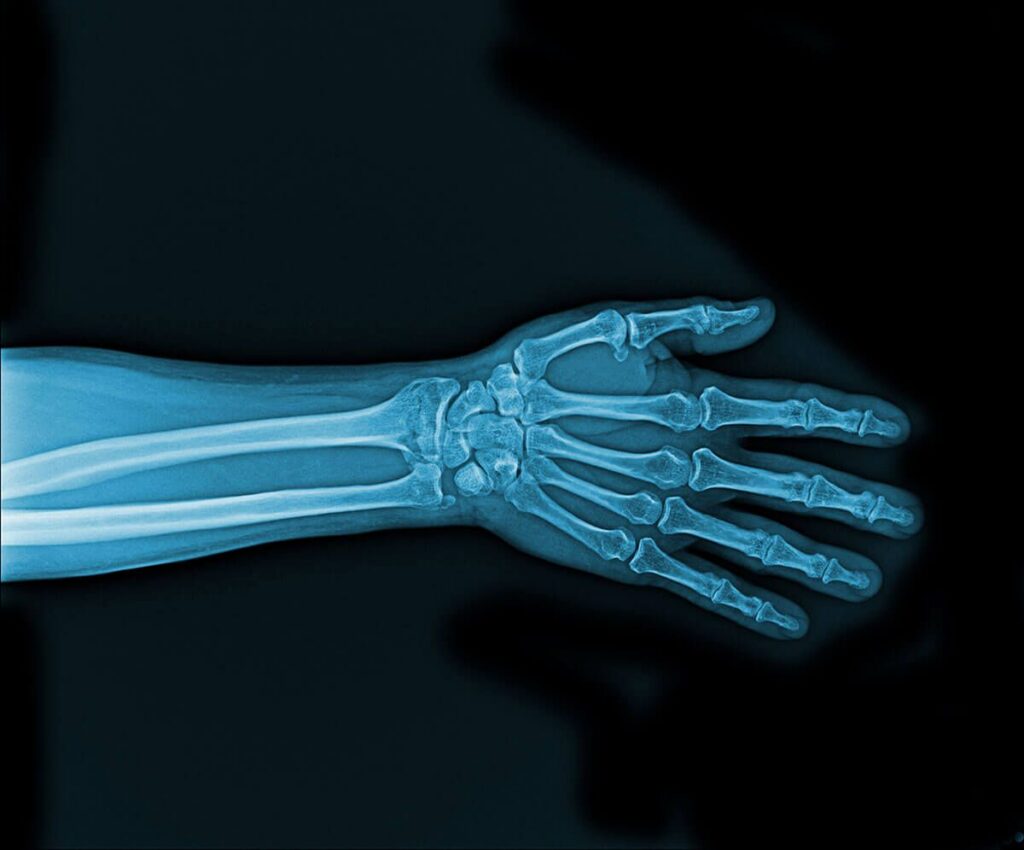 How the Mandatory “Broken Arm” Poster Protects Injured Workers’ Rights in Florida